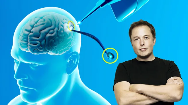 Â¿En qué consiste?: Elon Musk anunció que Neuralink implantó por primera vez un chip cerebral en un ser humano