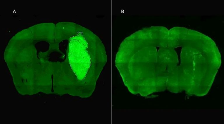 Especialistas del CONICET lograron frenar un tipo de cáncer cerebral con una novedosa estrategia terapéutica